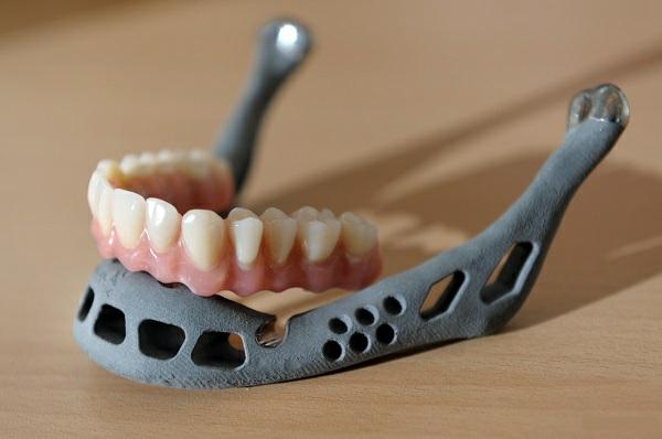 3D printing Dental Implants